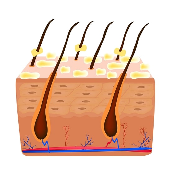 how-dandruff-can-be-removed
