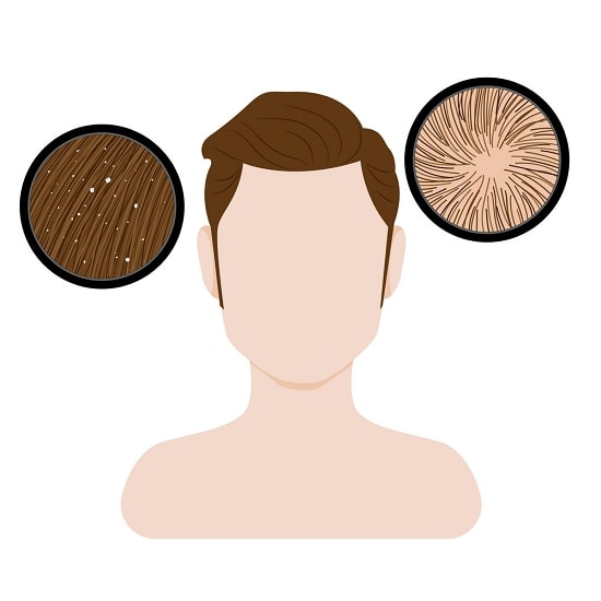 poor-scalp-hygiene-tips-to-get-rid-of-dandruff