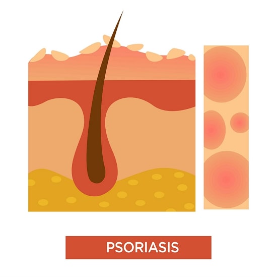psoriasis-how-to-deal-with-dandruff-and-itchy-scalp