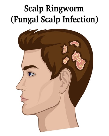 scalp-fungal-infection-dandruff-remedy-tips